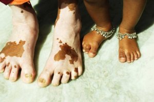 Vitiligo'da Olumlu Sonuçlar