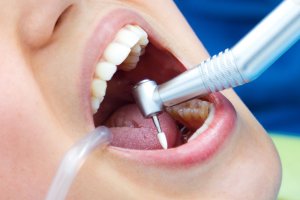 Diş Dolgusu Ağrısı Nasıl Geçer?