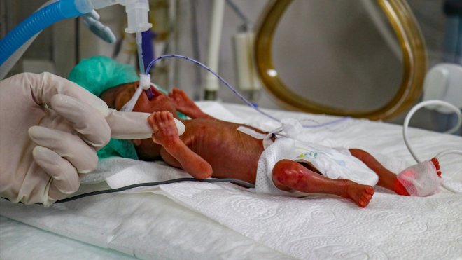 'Parmak bebek' sağlık çalışanlarının çabasıyla hayata tutunuyor