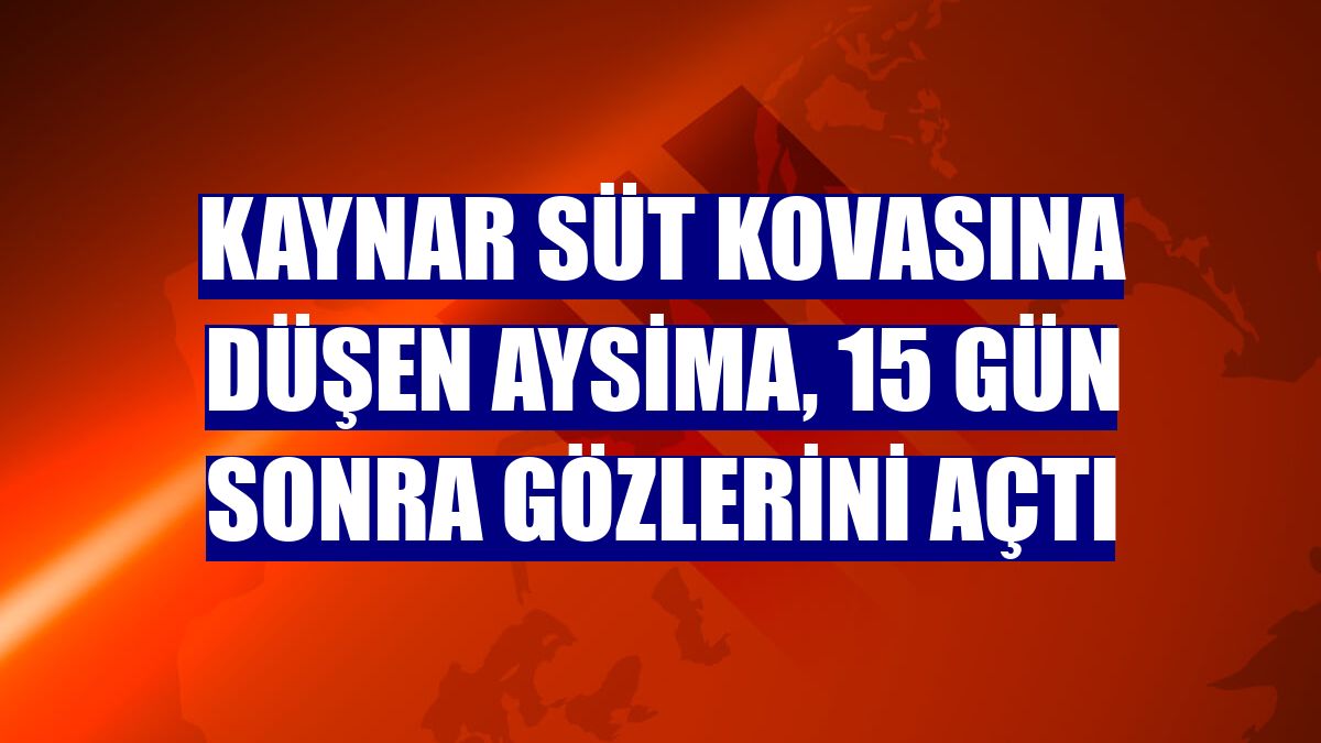 Kaynar süt kovasına düşen Aysima, 15 gün sonra gözlerini açtı