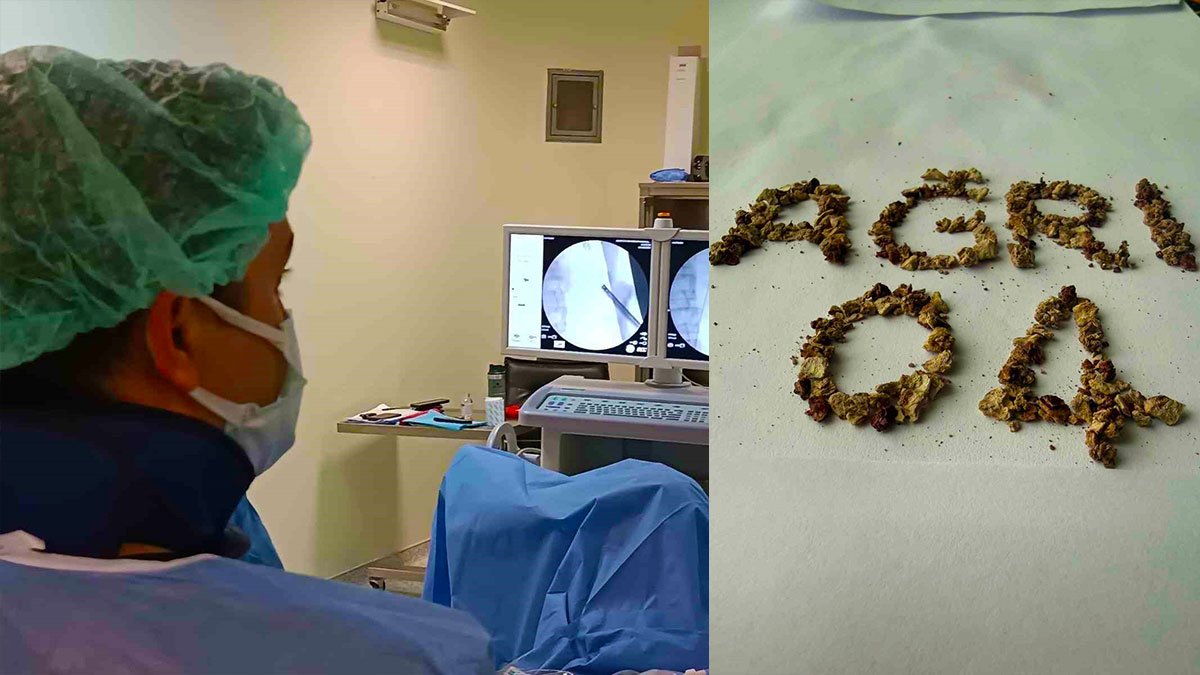 Ağrı Eğitim ve Araştırma Hastanesi’nde zorlu taş cerrahisi başarıyla yapıldı