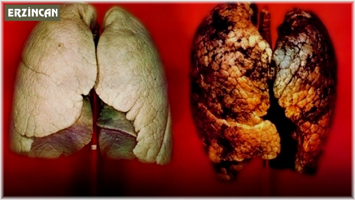 Akciğer kanserlerinin yaklaşık yüzde 90'ı tütün ve tütün ürünlerinin kullanımı ile oluşuyor