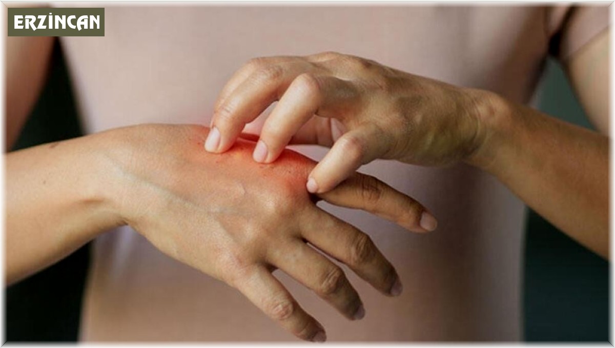 Baharda sık görülen 5 cilt hastalığı