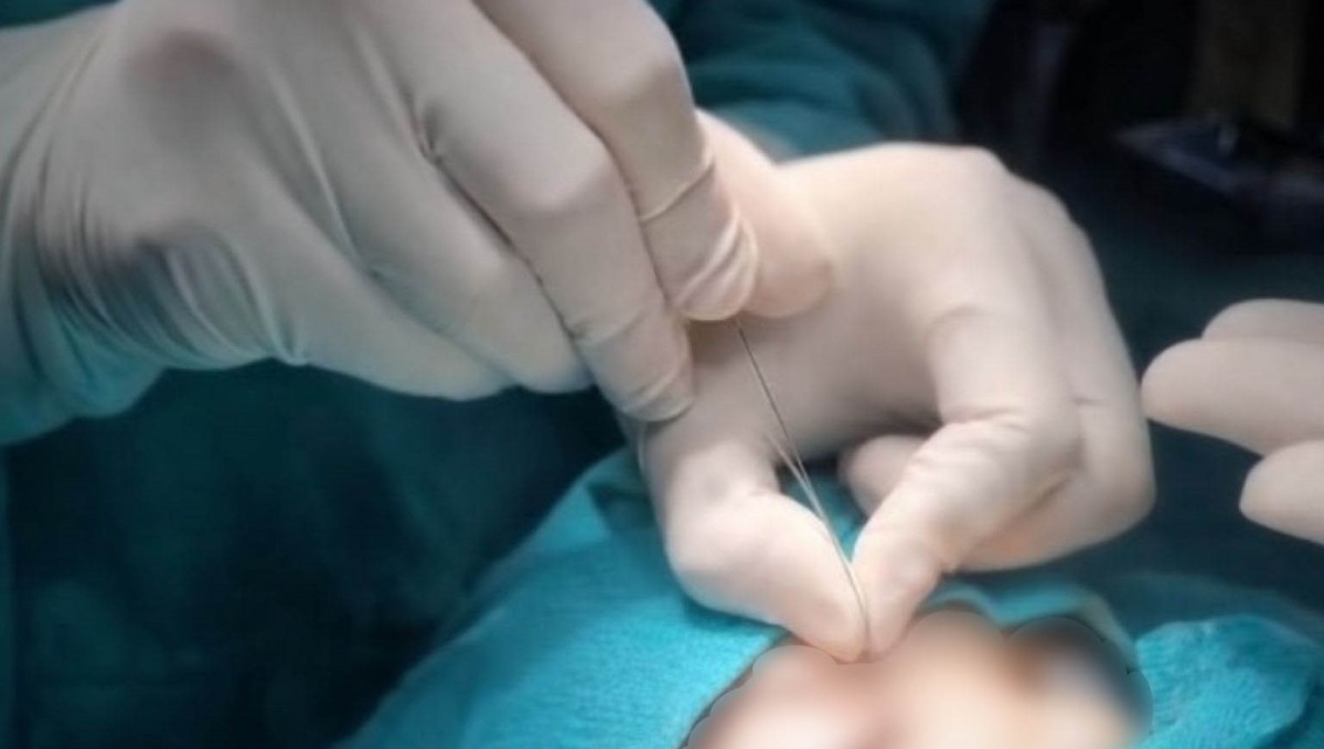 Çukurca’da önemli sağlık hizmeti: Gözyaşı kanalı ameliyatları ilçede yapılmaya başlandı