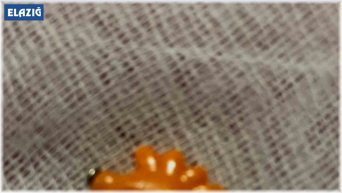 Elazığ'da 9 aylık bebeğin boğazına kaçan yabancı cisim başarıyla çıkartıldı