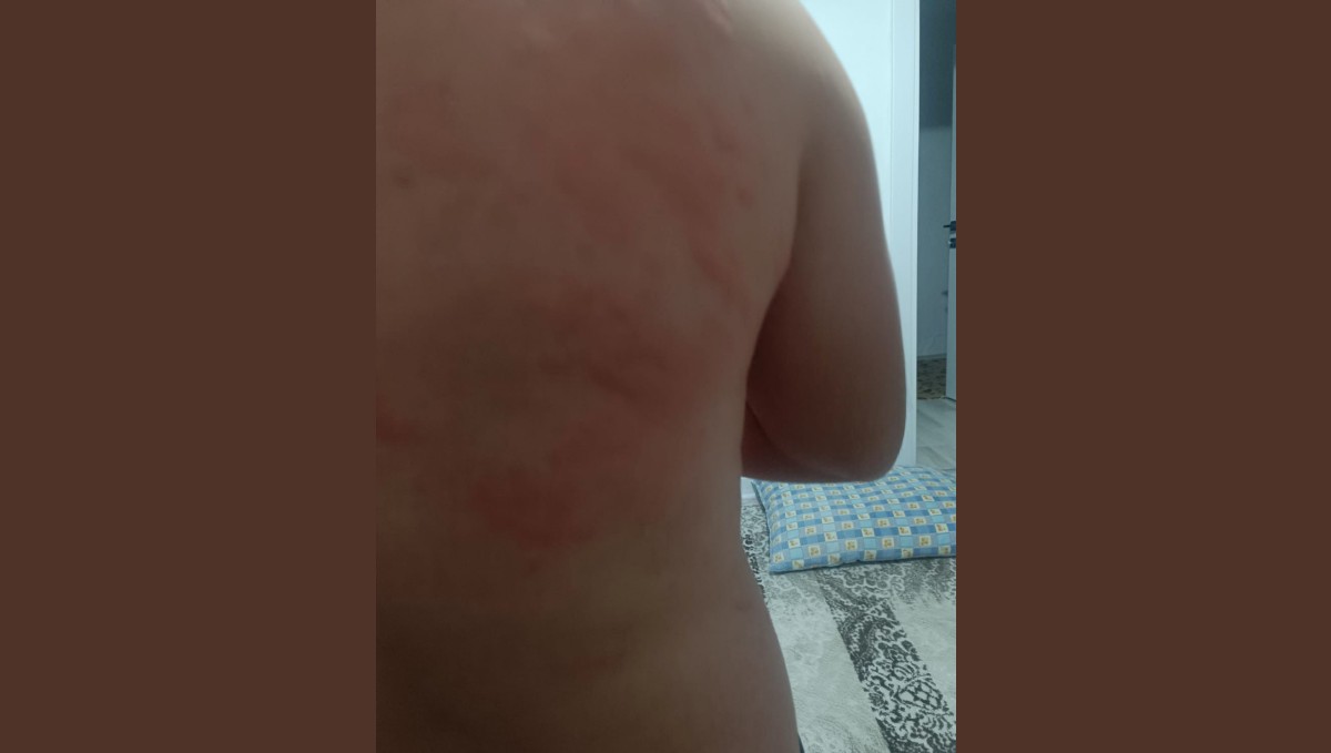 Elazığ'da böcek ısırığı hastanelik etti