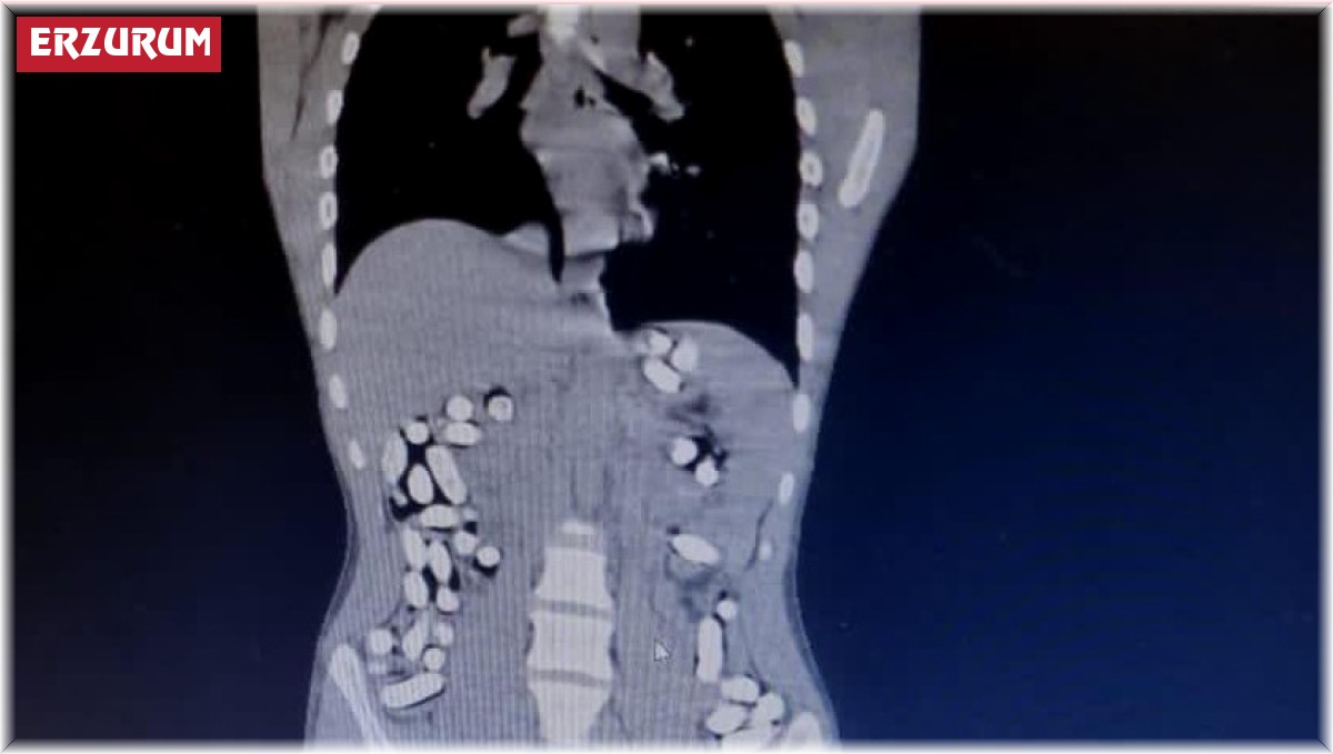 İran'dan gelen 5 kişinin midesinde 6 kilo 145 gram afyon sakızı ele geçirildi