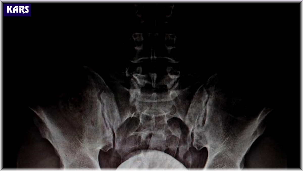 İran uyruklu şahsın mide ve bağırsaklarından uyuşturucu çıktı