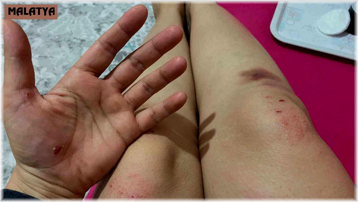 İşe giden kadına köpekler saldırdı