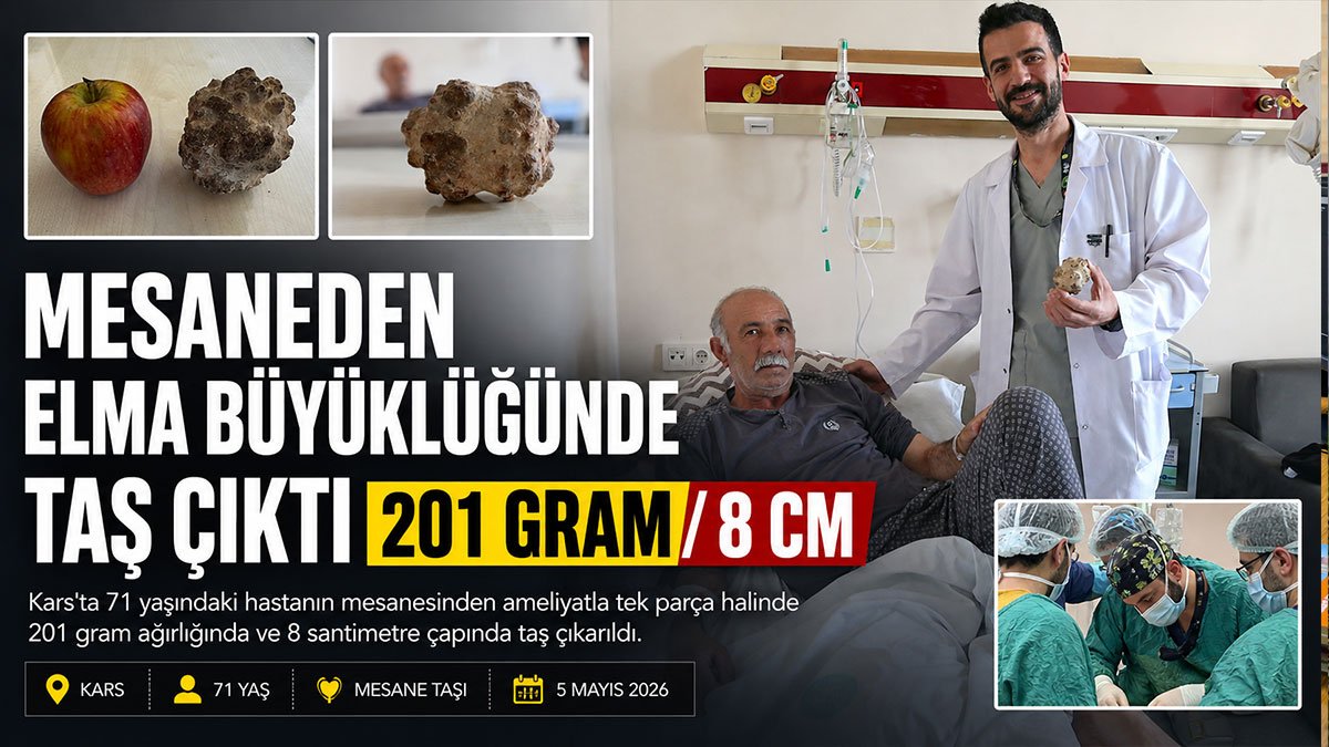 Kars'ta böbrek ağrısıyla hastaneye gitti, mesanesinden elma büyüklüğünde taş çıkarıldı