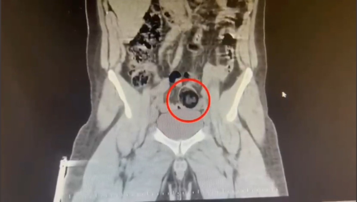 Kars'ta İranlı kuryenin makatından uyuşturucu çıktı
