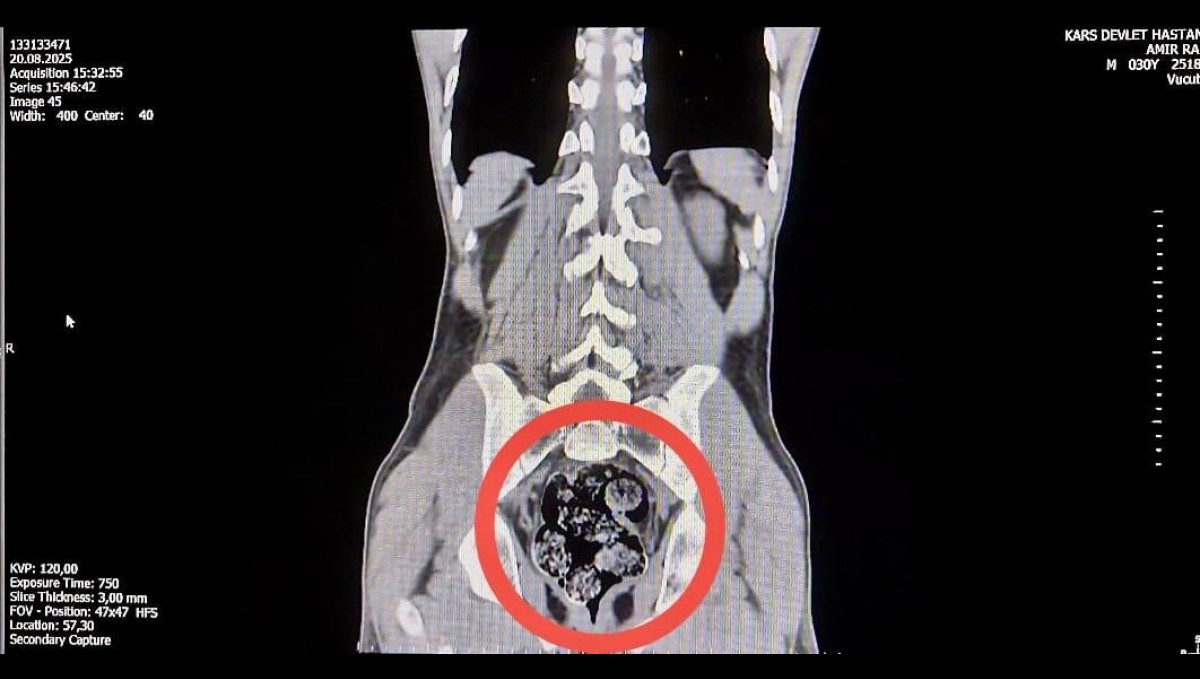 Kars'ta İranlı kuryenin makatından uyuşturucu çıktı