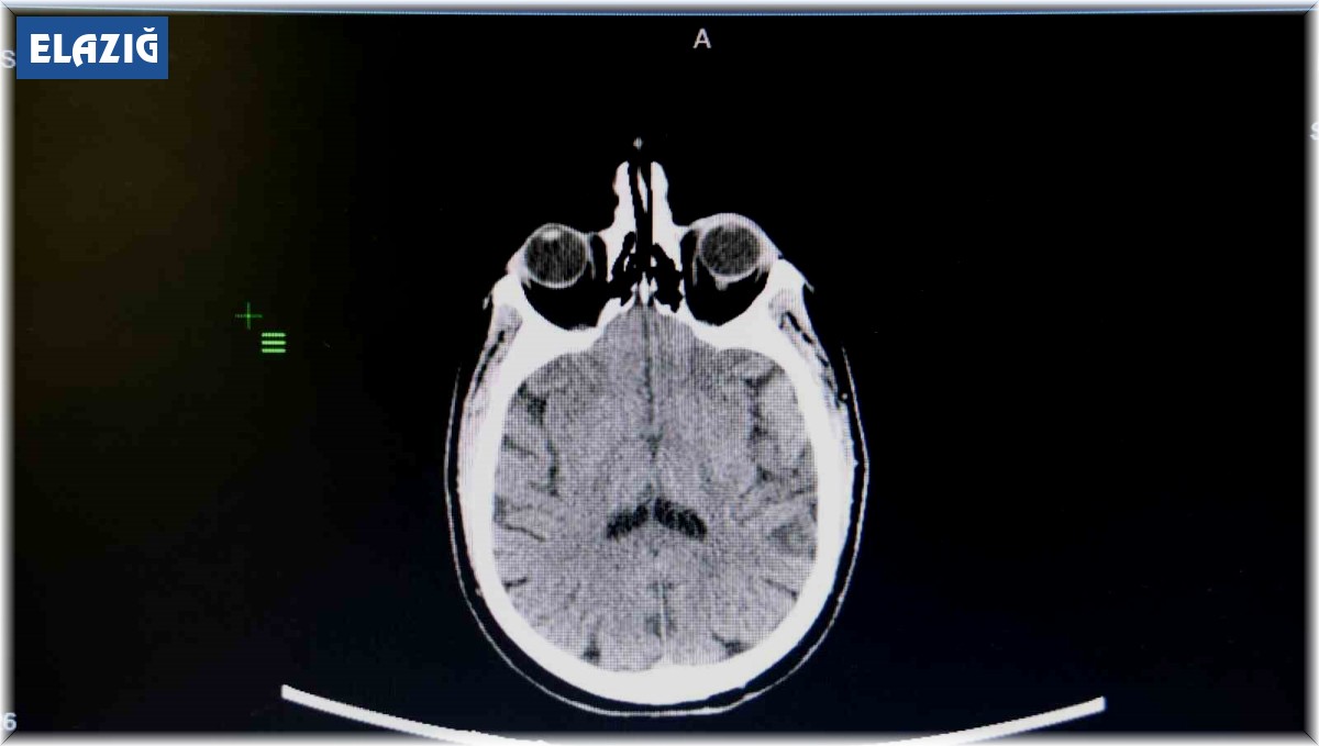 KBB Uzmanı Prof. Dr. Sakallıoğlu: "İşitme kaybının çok büyük bir kısmı tedavi edilebilmektedir"