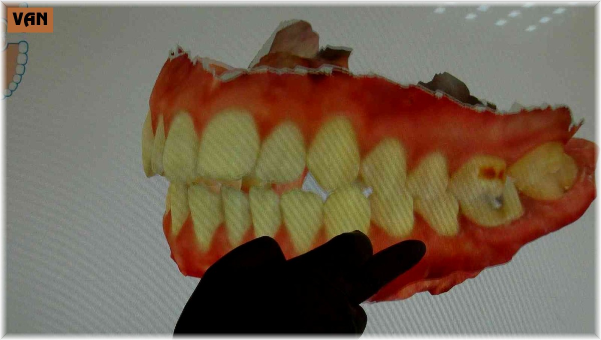 Korona virüs diş ağrılarını arttırdı