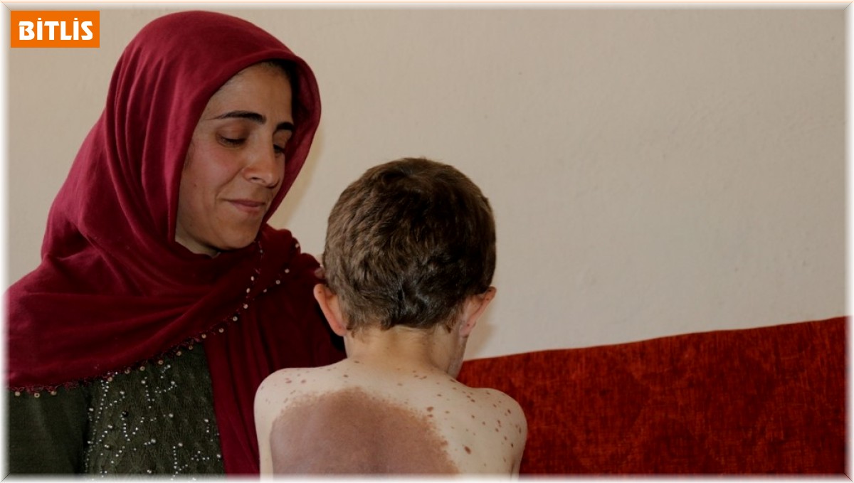 Küçük Samet vücudunu saran dev benlerin tedavi edilmesini istiyor