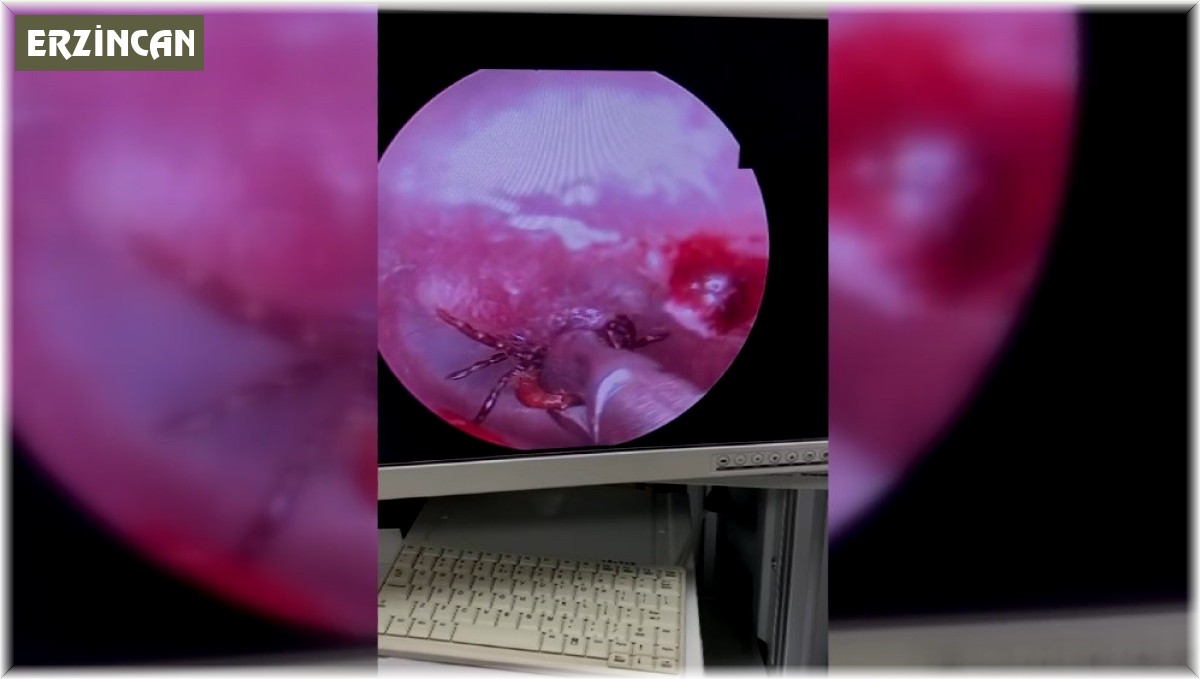 Kulak ağrısıyla hastaneye gitti, kulağından kene çıktı