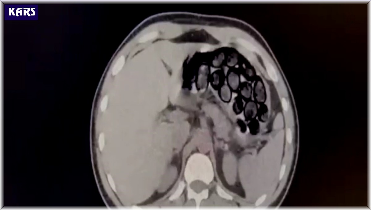 Mide ve bağırsağından 65 kapsül uyuşturucu çıktı