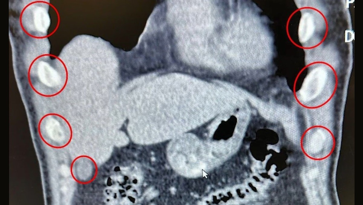 Midelerinden 136 kapsül uyuşturucu çıktı