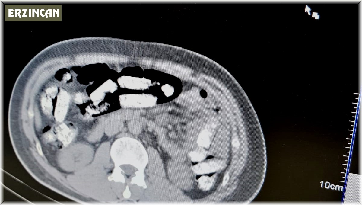 Midesinde uyuşturucu sevkiyatı yapan zanlı tutuklandı