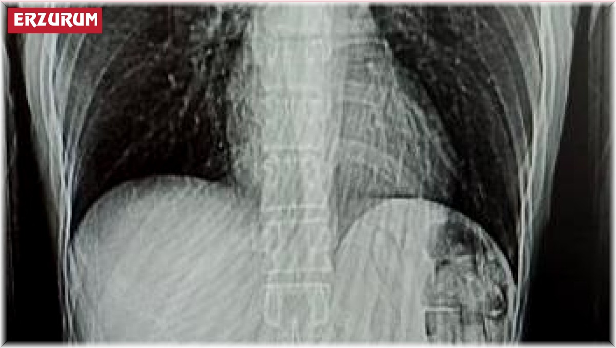 Midesinden 78 kapsül uyuşturucu çıktı