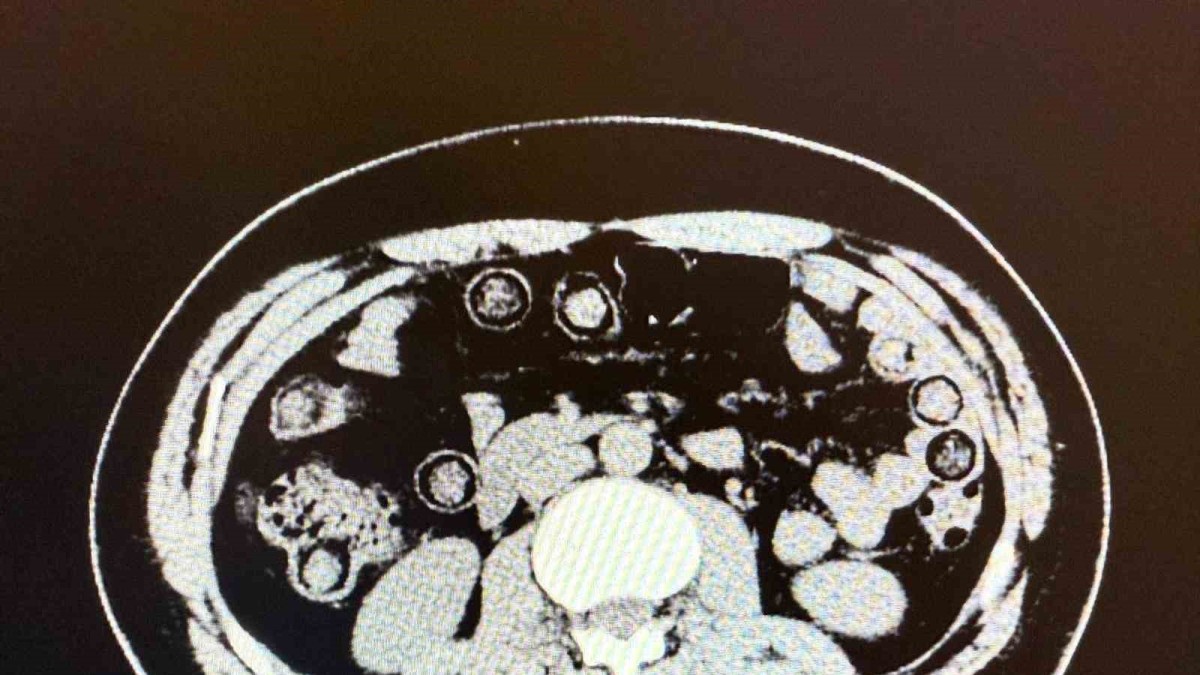 Muş'ta midelerinden 928 gram uyuşturucu çıkan 2 İranlı tutuklandı