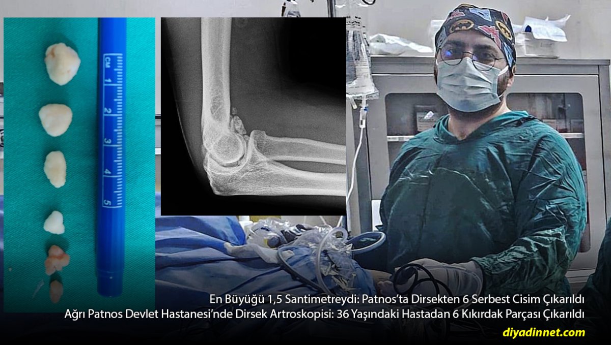 Patnos'ta Başarılı Dirsek Ameliyatı: Eklemden 6 Kıkırdak Parçası Çıkarıldı