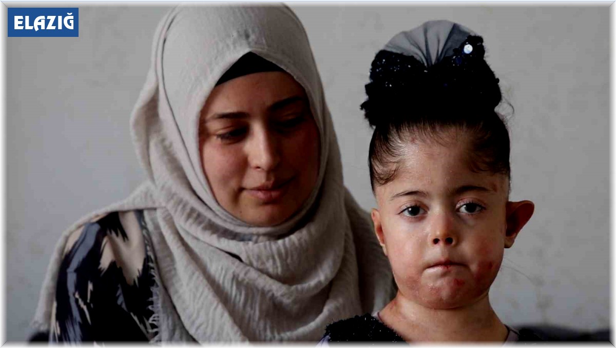 Tek dileği kelebek hastası kızına doyasıya sarılabilmek