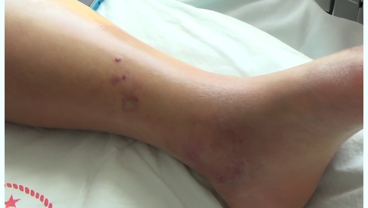 Tunceli'de koca engerek yılanının ısırdığı kadın, tedavi altına alındı