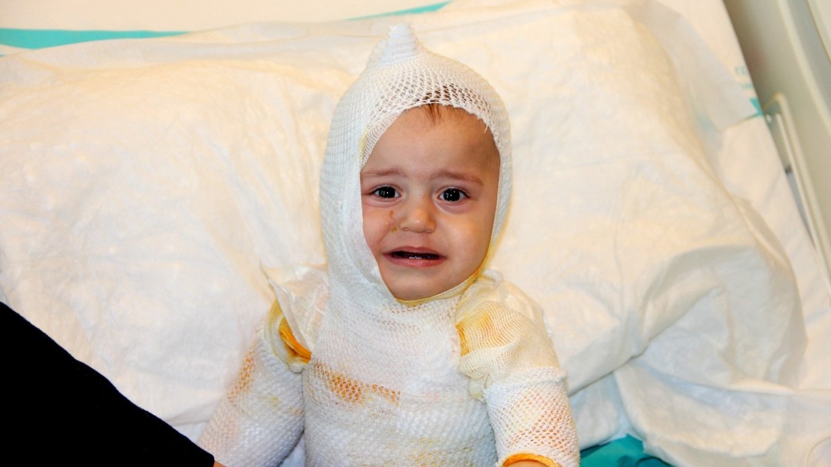 Üzerine kaynar süt dökülen 1 yaşındaki çocuk feci şekilde yandı