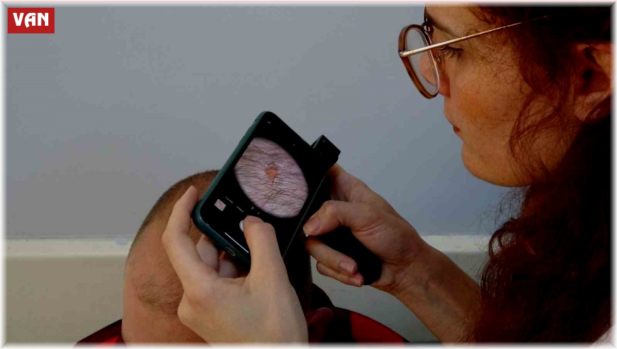 Uzmanlar uyardı: Ciltteki benler kansere dönüşebilir