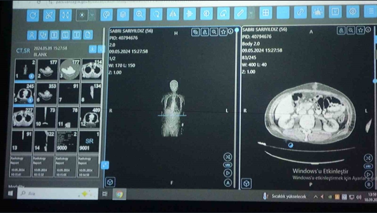 Van'dan dünyaya örnek çalışma: Kanser tedavisinde yapay zekâ kullanıldı