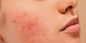 Rüyada Kabarcık Görmek