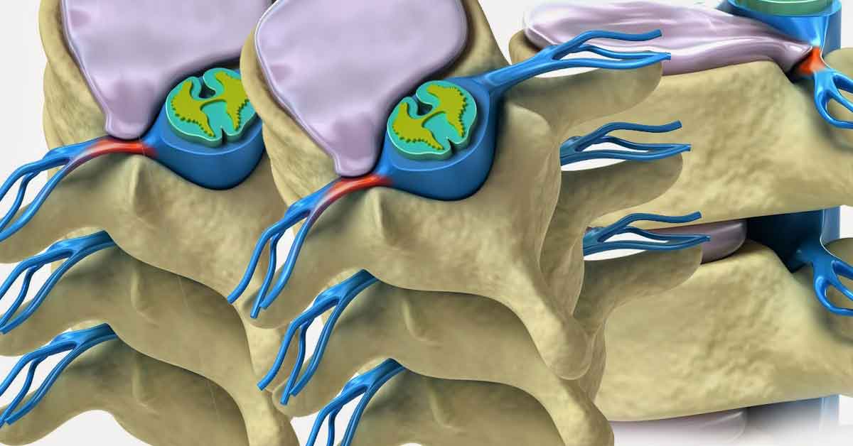 Nükleoplasti Nedir? Sorularla Nükleoplasti ve Tedavisi