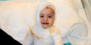 Üzerine kaynar süt dökülen 1 yaşındaki çocuk feci şekilde yandı
