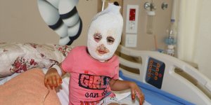 Sıcak suyla oynarken yanan minik Ayfer, Erzurum'da tedaviye alındı