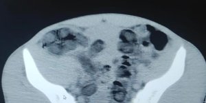 Bitlis 2 şahsın midesinden 1 kilo 96 gram eroin çıktı