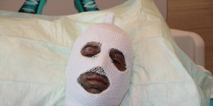 Piknik tüpünü yakarken parlama sonucu yaralanan esnafın Erzurum'da tedavisi sürüyor