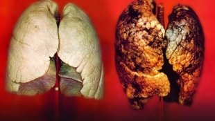 Akciğer kanserlerinin yaklaşık yüzde 90'ı tütün ve tütün ürünlerinin kullanımı ile oluşuyor
