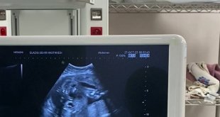 Anne karnındaki bebeğe stent takıldı