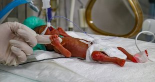 'Parmak bebek' sağlık çalışanlarının çabasıyla hayata tutunuyor
