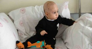 Kafatasında şekil bozukluğu olan 7 aylık bebek ameliyat edildi