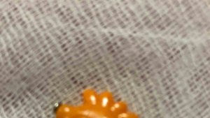 Elazığ'da 9 aylık bebeğin boğazına kaçan yabancı cisim başarıyla çıkartıldı