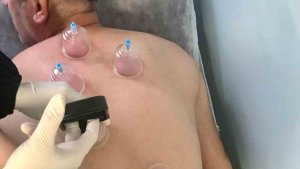 Genç Devlet Hastanesinde hacamat polikliniği hizmete girdi