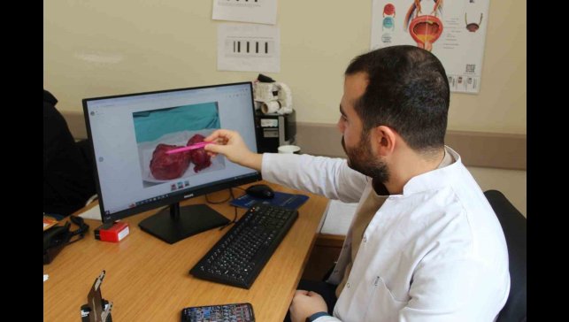 300 gramlık prostat dokusu başarıyla çıkarıldı