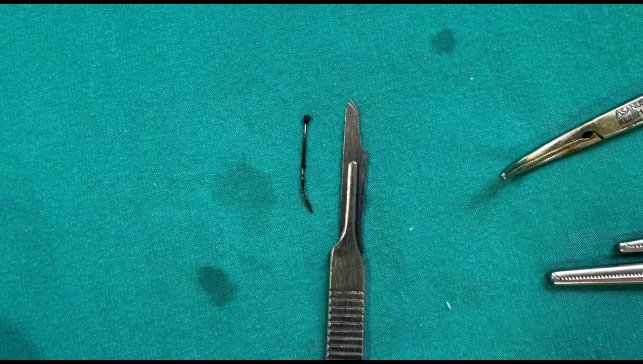 5 yaşındaki çocuğun yuttuğu toplu iğne ameliyatla çıkarıldı