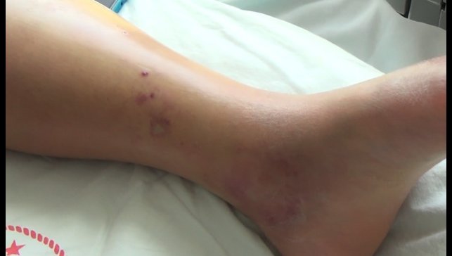 Tunceli'de koca engerek yılanının ısırdığı kadın, tedavi altına alındı