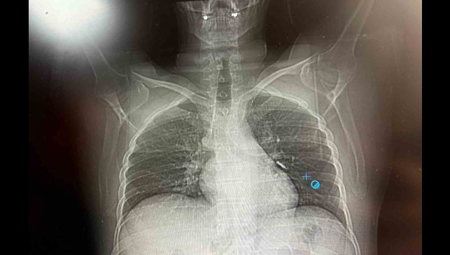 İmplant vidası ciğerine kaçan hasta ölümden döndü