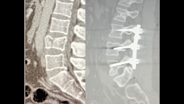 Yüksekten düşen hasta, Patnos'ta ilk kez uygulanan ameliyatla ayağa kalktı