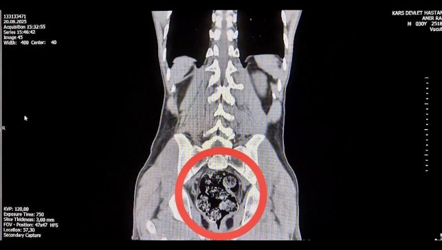 Kars'ta İranlı kuryenin makatından uyuşturucu çıktı