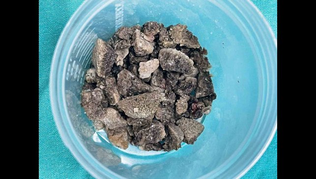 8 santimetrelik 'geyik boynuzu' böbrek taşı kapalı yöntemle çıkarıldı